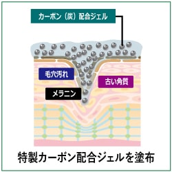 光カーボンピーリング工程①