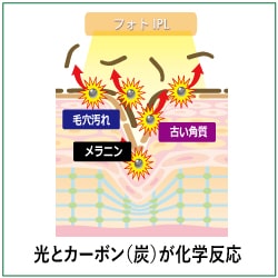光カーボンピーリング工程②